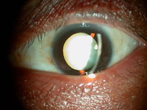 一、  现代医学视域下的眼睑痉挛病理机制分析