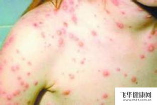 第三章 油腻煎炸类食品的不良影响机制