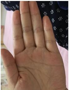 男人和女人手相相似，女人右手有黑痣，这样的手相改写为是：男人和女人手相相似，女人右手有黑痣，这样的手相好不好？