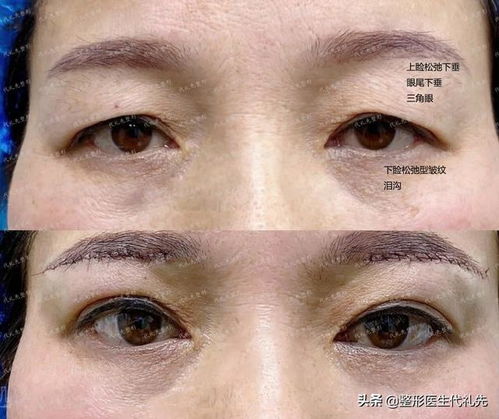 割双眼皮10年后照片中，双眼皮风水的改变是否依然明显？