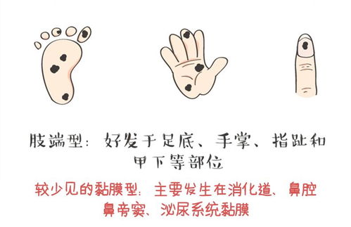 痣相与健康隐患之间的关联