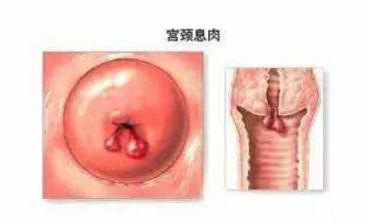 3. 宫颈息肉