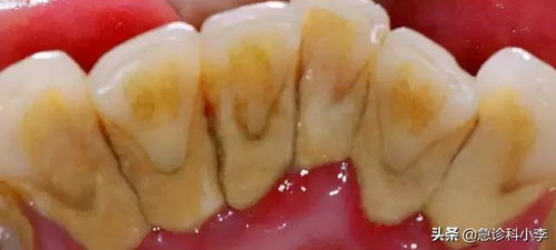 二、  龈下刮治术的必要性及其操作规范