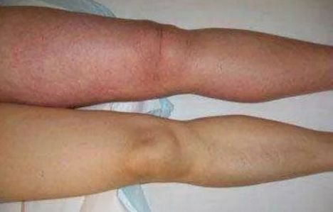 梦见腿被吃掉或被咬，是什么预兆或含义？