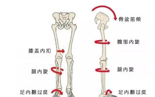 怎样缓解盆骨前倾引起的腰痛？