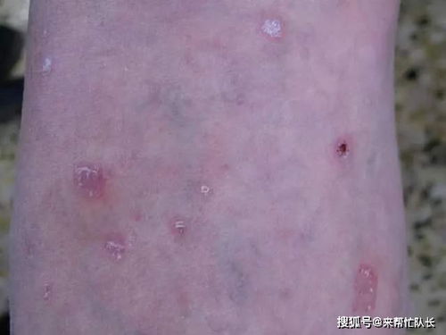 二、 系统性红斑狼疮：八字五行失衡下的条款陷阱