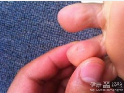 手术鸡眼是哪个生肖的人容易得？鸡眼断根的最简单方法是什么？