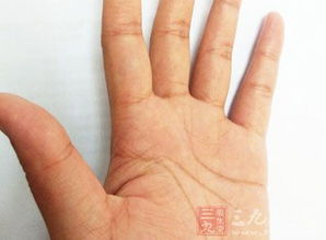 1. 起始端双纹合并——痛风风险升高