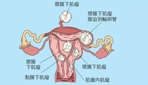 刮宫是常态：切除病灶才能安心