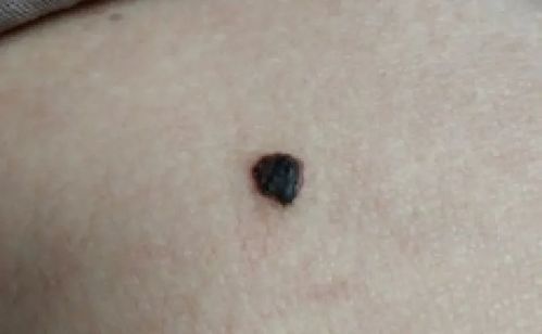 手背痣的形态学特征及其潜在风险