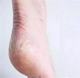 女人梦见脚后跟有污垢是什么征兆？