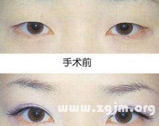 男生三眼皮面相好吗？左上眼皮小疙瘩是啥面相？