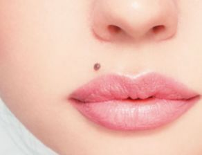 如何区分面部痣和雀斑，判断常见色斑与痣的区别？