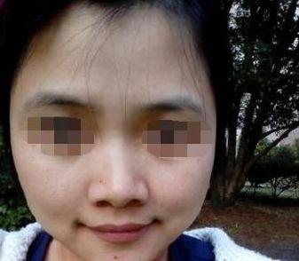 眼皮多重