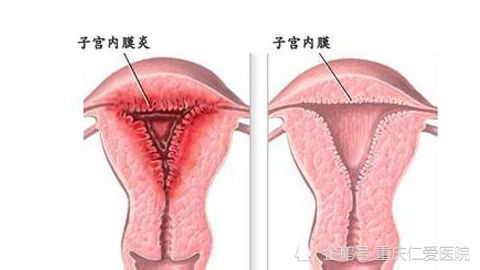 2. 子宫内膜炎