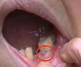 拔光牙齿镶金牙的女人命运如何？吉凶如何？