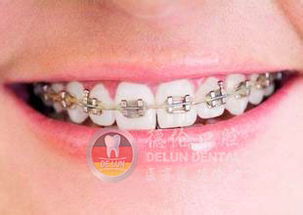 下牙八字牙的人，右边的下牙究竟叫什么牙？