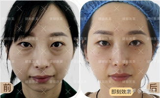 卧蚕与眼袋之差异的系统性探讨