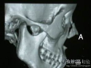 1. 疼痛感知：典型且不可忽视的首要信号