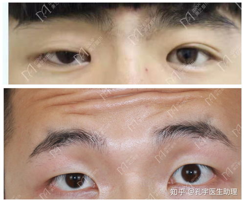 左右眼兆吉凶，左右眼睛大小眼怎么办？如何改善？