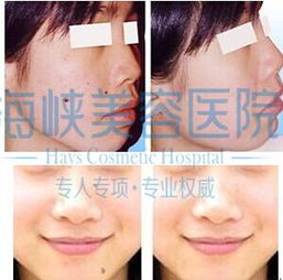 去痣前需要先算八字和做检查吗？
