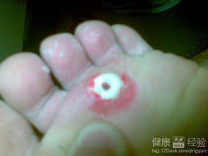 手术鸡眼是哪个生肖的人容易得？鸡眼断根的最简单方法是什么？