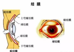 （三）炎症性眼部病症的直接诱因