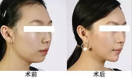 一、 高颧骨的生理与人类学基础