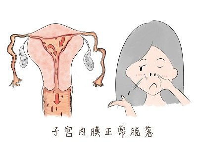 3. 子宫内膜异位症