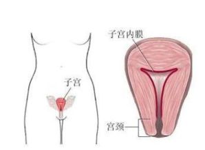 4. 子宫内膜息肉：