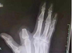 梦见右手食指被蛇咬断，这究竟是什么预兆？