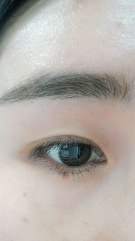 3. 睫毛处有痣