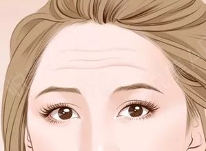 二、 不同形态的抬头纹