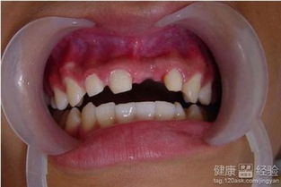 先天性牙齿缺失预示着怎样的命运？会有哪些相关症状？