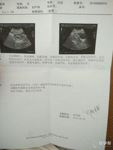 哪些情况下看不到胎心/胎芽？