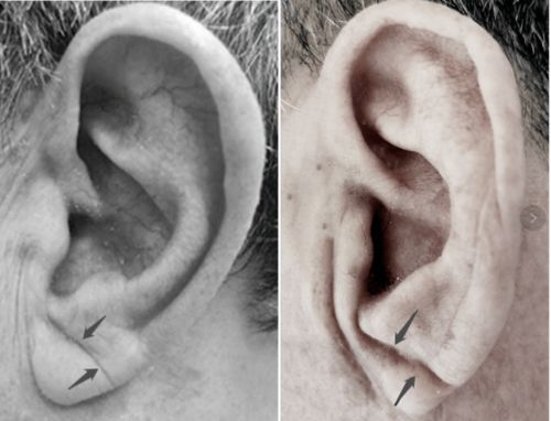 一、  天庭区域疤痕对仕途与思考力的潜在影响