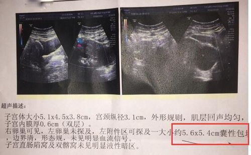 1.1 卵巢更多囊症（PCOS）——它不是电脑游戏