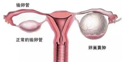 囊肿的类型较大家族：它们都能干扰月经吗？
