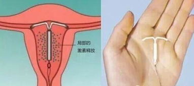 上环后的心理状态调适