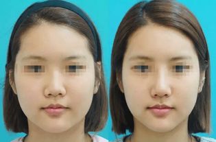 鼻骨宽面相是否更佳？