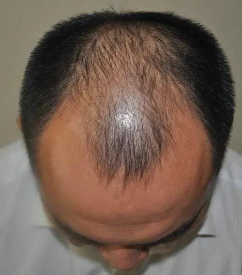 我为什么总是梦见自己一把一把地掉头发，是预示着什么吗？