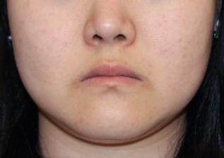 六、  脸颊部位胎记的性格与命运投射