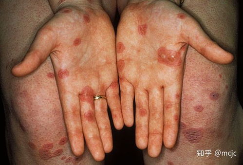 八字中哪些组合容易导致皮肤病？