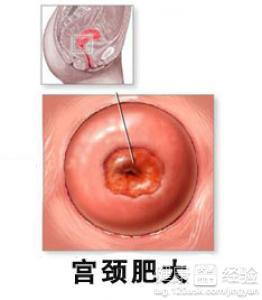 1.1 典型表现：疼痛、出血还是无症状？