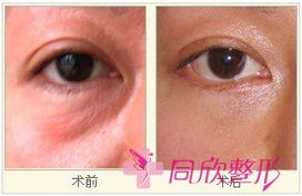 男人面相眼袋看寿命准吗？有没有治疗眼袋的最佳方法？