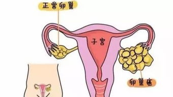 乱七八糟的名字游戏：卵巢囊肿恶性版
