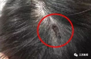 周公解梦中掉头发露头皮是什么征兆？