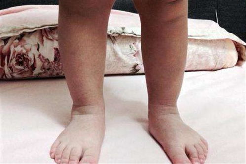 新生男宝宝五个月脚外八字如何纠正？