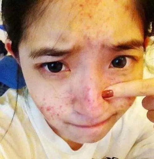 脸上长痘痘的梦境是什么意思？