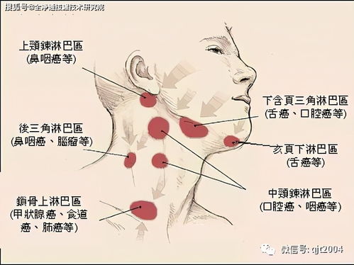 脖子上长痣的另一种说法：